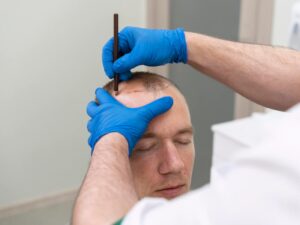 Jak dbać o włosy po przeszczepie włosów